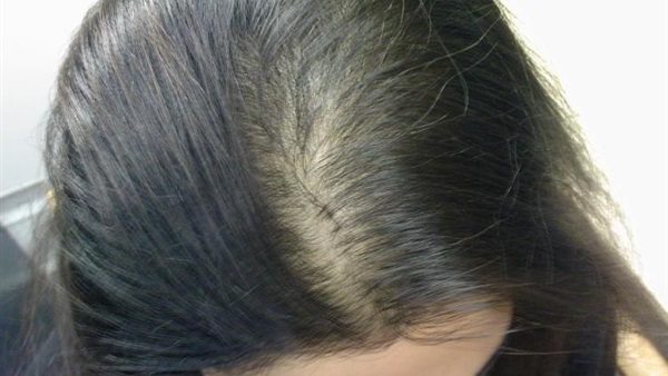 تعرف الآن على أشهر أسباب تساقط الشعر عند النساء وطرق العلاج الفعالة