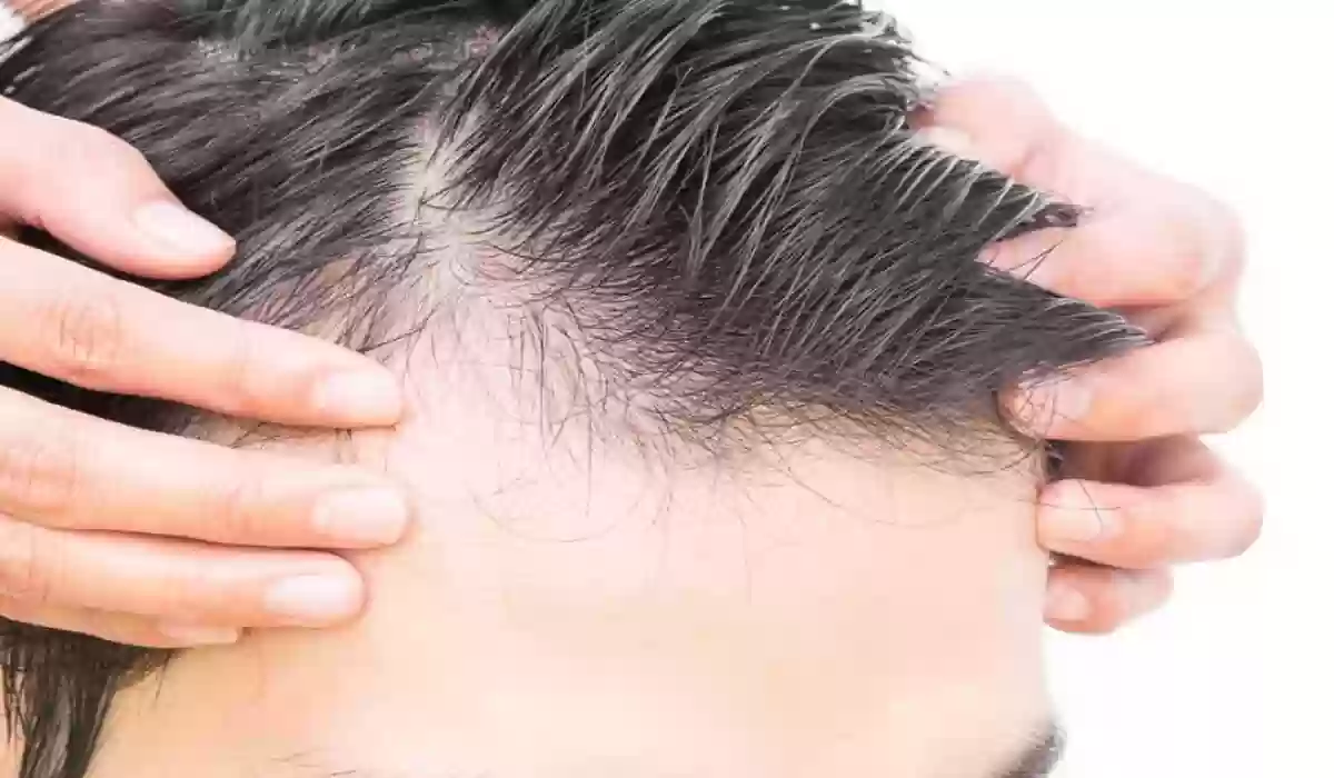 جهاز انبات الشعر بالليزر
